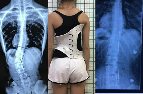 3D打印技術在骨科的實際應用有哪些？(圖4)